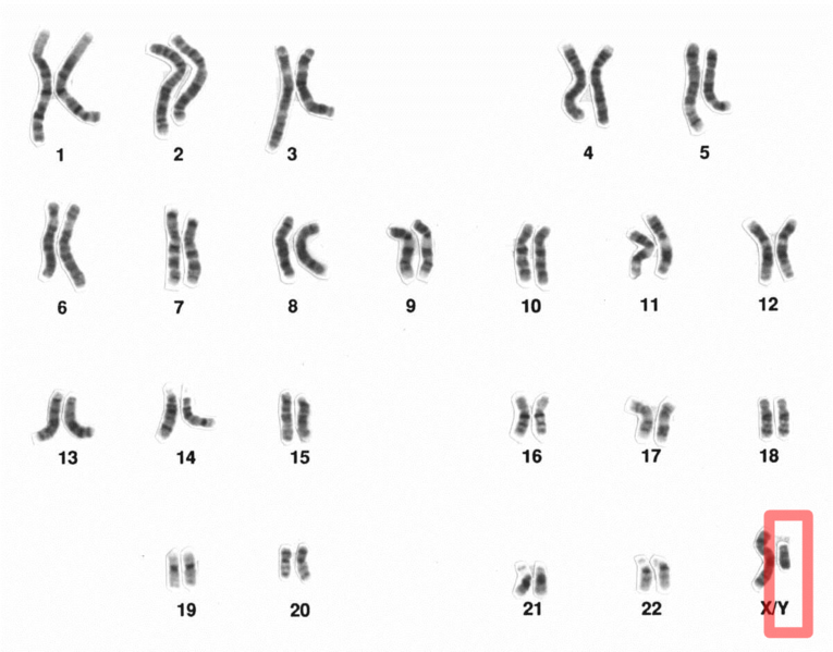 Un cariotipo (colección de cromosomas) humano con el Cromosoma Y señalado en rojo.